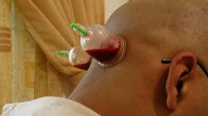 حجامة للظهر والرقبة الطائف