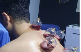 جلسات حجامة بالطائف