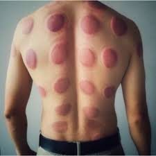 حجامة رطبة الطائف