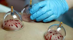 حجامة للصداع النصفي الطائف