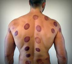 حجامة للعصب الطائف