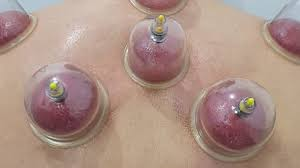 عيادة لمسة شفاء للحجامة