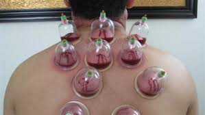 image 45 حجامة وقائية الطائف