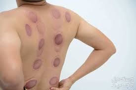 image 47 مركز حجامة موثوق الطائف