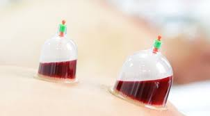 حجامة بدون جراحة الطائف