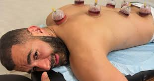 حجامة لعلاج الإرهاق الطائف