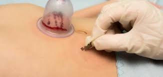 حجامة لتحسين الصحة العامة الطائف