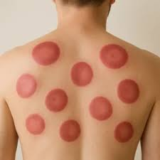 حجامة للضغط المرتفع الطائف