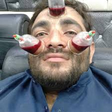 حجامة مع تعقيم كامل الطائف