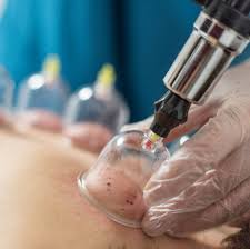 حجامة علاجية للصداع الطائف